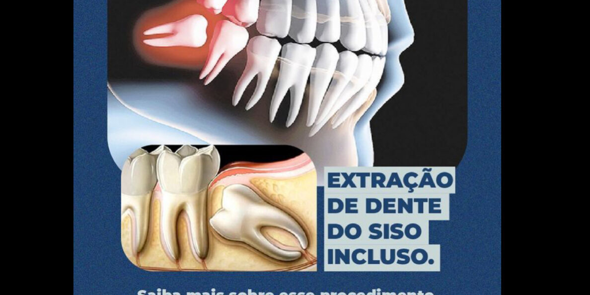 ExtraÇÃo De Dente Do Siso Incluso Clínica Ceconi 7511